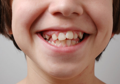 Child with crooked teeth
